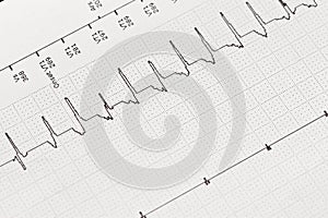 Electrocardiogram, Cardiac Arrhythmia