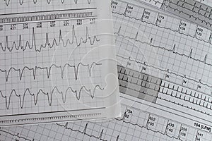 Electrocardiogram with cardiac arrhythmia. Patient with atrial fibrillation and atrial flutter