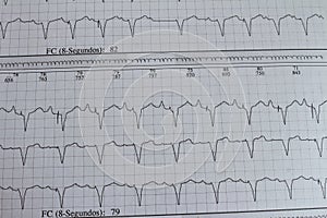 Electrocardiogram with cardiac arrhythmia. Patient with cardiac pacemaker