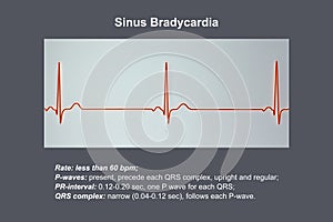 Electrocardiogram displaying sinus bradycardia, 3D illustration photo