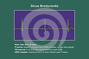 Electrocardiogram displaying sinus bradycardia, 3D illustration photo