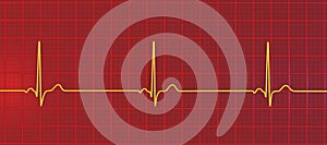 Electrocardiogram ECG displaying sinus bradycardia, 3D illustration photo