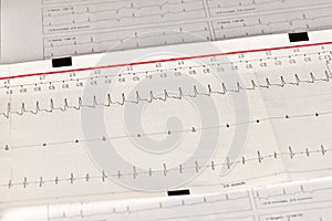 Electrocardiogram ECG / EKG with cardiac arrhythmia