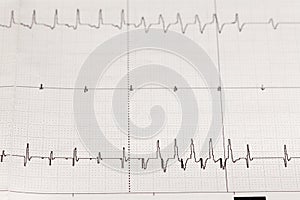 Electrocardiogram ECG / EKG with cardiac arrhythmia