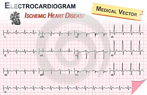 Electrocardiogram ( ECG , EKG ) of Ischemic Heart Disease ( Myocardial Infarction ) and Anatomy of heart icon