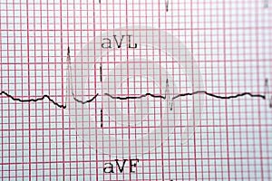 Electrocardiogram ECG in a graph paper shows normal Sinus rhythm, Vital signs and medical healthcare symbol