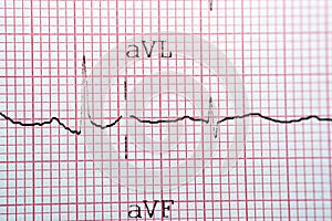 Electrocardiogram ECG in a graph paper shows normal Sinus rhythm, Vital signs and medical healthcare symbol