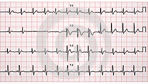 Electrocardiogram, ECG, heartbeat, vector