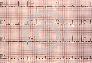 Electrocardiogram in paper form. Analog electrocardiographic recording. ECG example photo