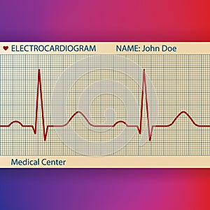 Electrocardiogram Paper with Normal ECG