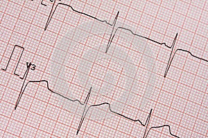 Electrocardiogram Printout