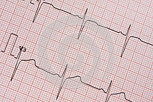Electrocardiogram Printout photo