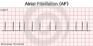 Electrocardiogram show Atrial fibrillation AF.