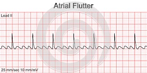 Electrocardiogram show Atrial flutter pattern.