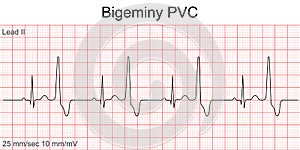 Electrocardiogram show Bigeminy PVC pattern.