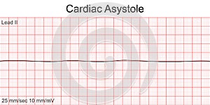 Electrocardiogram show Cardiac asystole pattern.