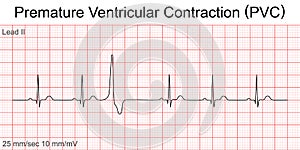 Electrocardiogram show Premature Ventricular Contraction PVC pattern.