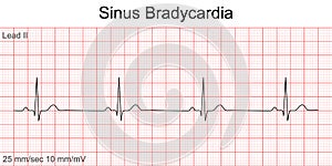 Electrocardiogram show Sinus bradycardia pattern. photo