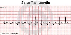 Electrocardiogram show Sinus tachycardia pattern.