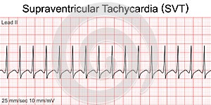 Electrocardiogram show Supraventricular tachycardia SVT pattern.