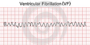 Electrocardiogram show ventricular fibrillation VF pattern. photo