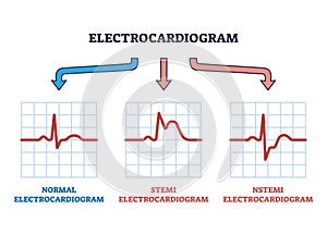 Electrocardiogram STEMI and NSTEMI abnormal heart rate outline diagram