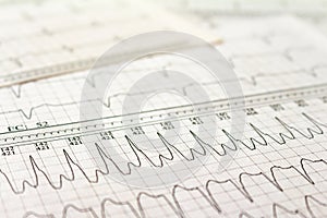 Electrocardiogram strips with cardiac arrhythmias. Atrial fibrillation Selective focus on some beats. Free space to write photo