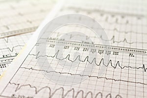 Electrocardiogram strips with cardiac arrhythmias. Ventricular tachycardia Selective focus on some beats. Free space to write