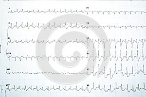 Electrocardiogram test results for myocardial ischemia diagnosis