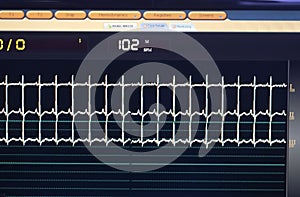 Electrocardiogram tracings on a cardiac monitor