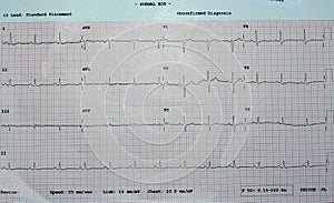 An ElectroCardioGraph ECG, a chart that draws the electricity of the heart and gives an idea on the heart condition and the rhythm