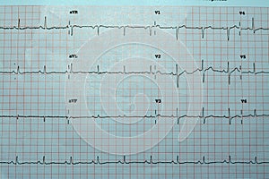 An ElectroCardioGraph ECG, a chart that draws the electricity of the heart and gives an idea on the heart condition and the rhythm