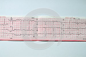 An ElectroCardioGraph ECG, a chart that draws the electricity of the heart and gives an idea on the heart condition and the rhythm