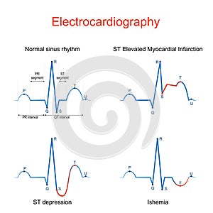 Electrocardiography. ECG or EKG