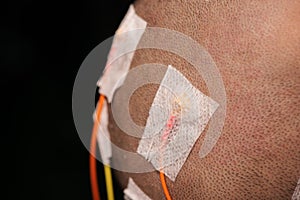 Electrodes for scalp electroencephalograohy examination