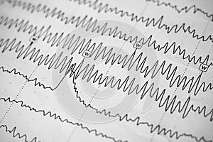 Electroencephalogram result on paper closeup, brain activity test
