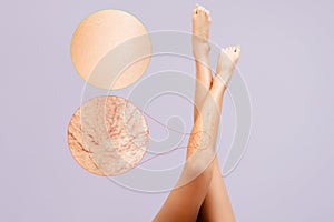 Elegant female legs on a pale lilac background. Enlarged area of vascular asterisks on the leg. Results before and after