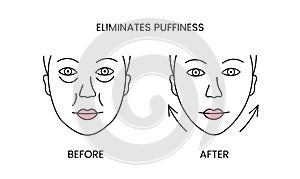 Eliminates puffiness, laser cosmetology before procedure and after applying treatment line icon in vector. Illustration