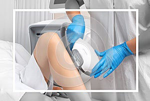 Elos epilation hair removal procedure on a womans body. Beautician doing laser rejuvenation on the lower leg in a beauty salon