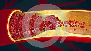 Embolism caused by a blood clot in a constricted blood vessel