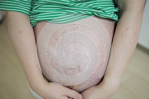 Embracing Motherhood Asian Pregnant Woman with Stretch Marks Lovingly Holds Belly