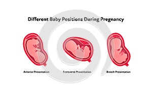 Embryo in womb medical diagram. Vector flat healthcare illustration. Different baby position during pregnancy. Anterior, photo