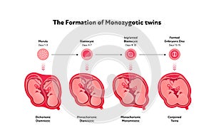 Embryo in womb medical diagram. Vector flat healthcare illustration. Formation of monozygotic twins. Design for health care,