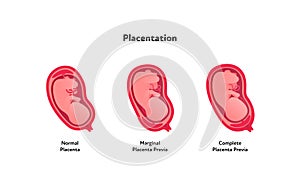 Embryo in womb medical diagram. Vector flat healthcare illustration. Placentation scheme. Normal, marginal and complete previa.