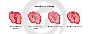 Embryo in womb medical diagram. Vector flat healthcare illustration. Placentation of twins in uterus during position. Design for photo