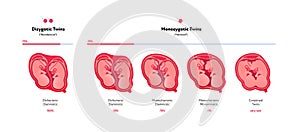 Embryo in womb medical diagram. Vector flat healthcare illustration. Placentation of twins in uterus during position. Monozygotic