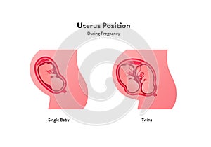 Embryo in womb medical diagram. Vector flat healthcare illustration. Uterus position during pregnancy. Single baby and twins. photo