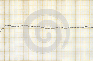 Emergency cardiology. ECG tape with ventricular fibrillation