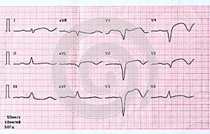 ECG with acute period of large-focal widespread anterior myocardial infarction photo