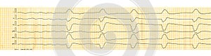 Emergency cardiology and resuscitation. ECG with slow idioventricular rhythm